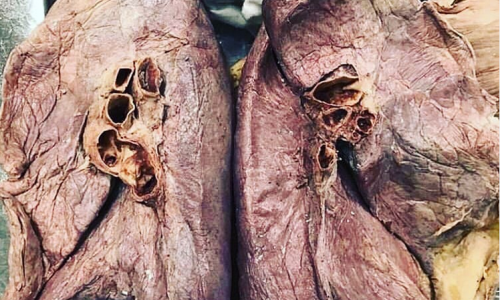 Sağ akciğer ile sol akciğer arasındaki anatomik farklılıkları biliyor musunuz? - 2019.04.03