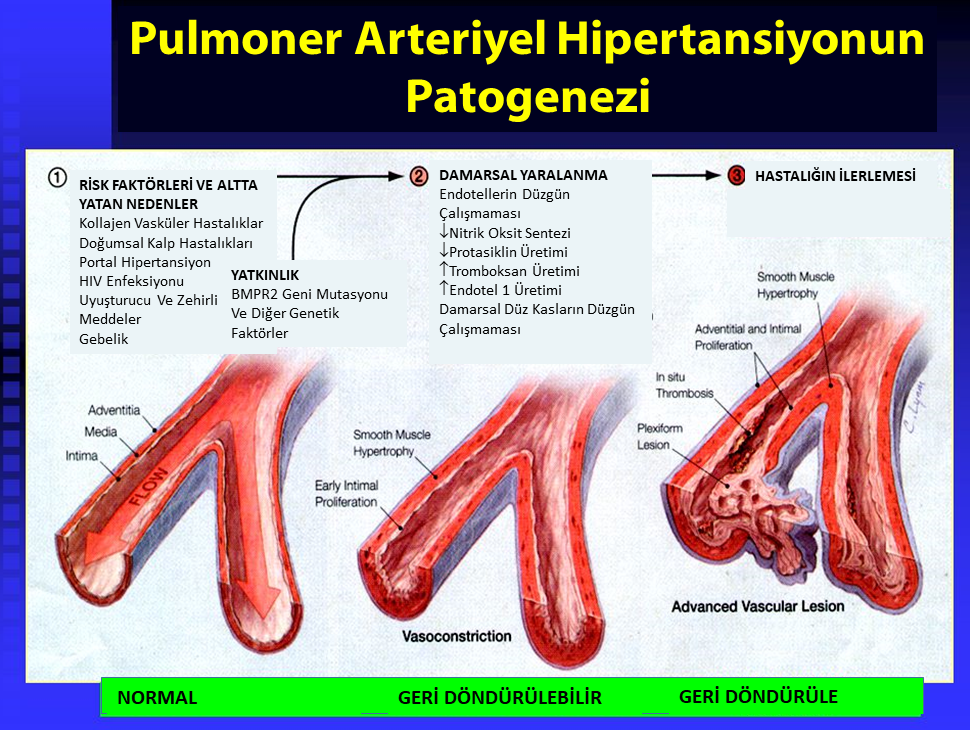 pulmoner arteriyel hipertansiyon belirtileri