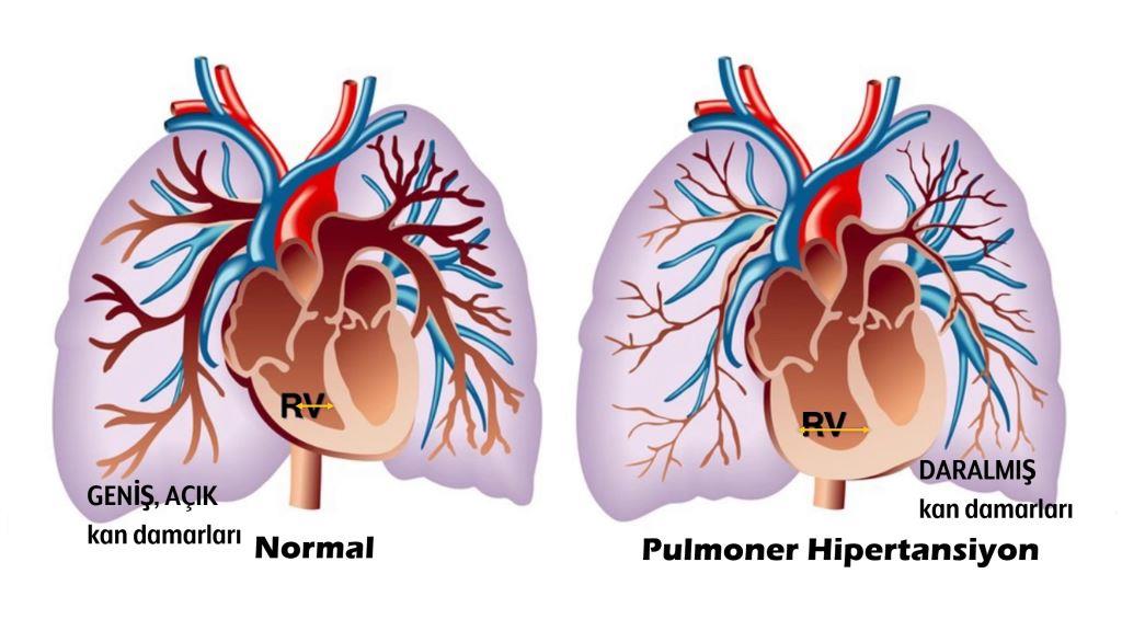 solunum sistemi hastalıkları durumunda pulmoner hipertansiyon)