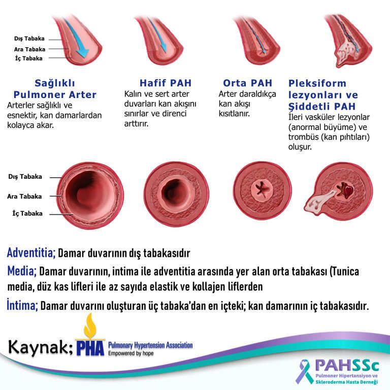 Pulmoner Arteriyel Hipertansiyon (PAH)